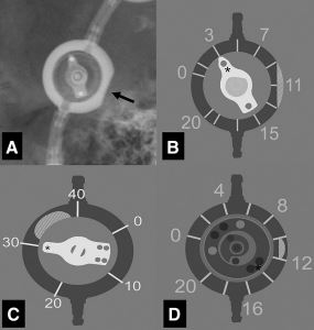Aesculap programmable shunt valve settings reference