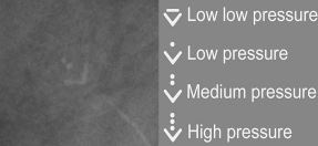 Medtronic CSF shunt valve setting reference